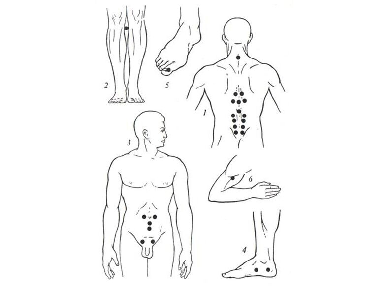 Suathaireacht acupuncture